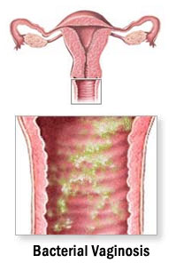 Бактериальный вагиноз при беременности